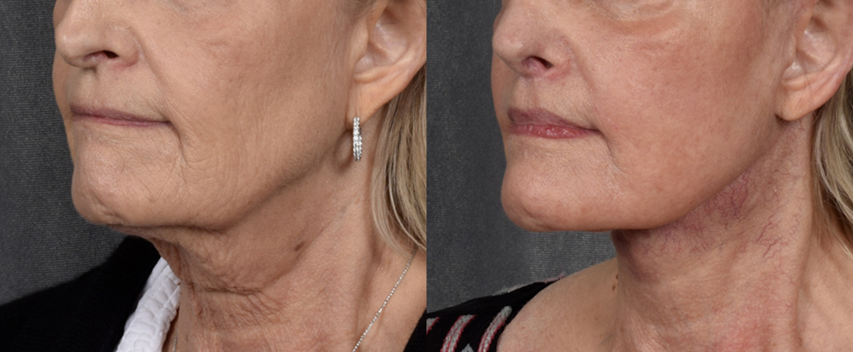 Lip Lift Before & After Gallery - Patient 282611 - Image 2