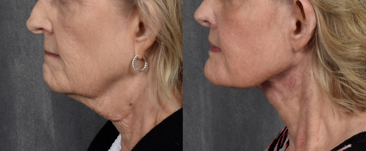 Lip Lift Before & After Gallery - Patient 282611 - Image 3