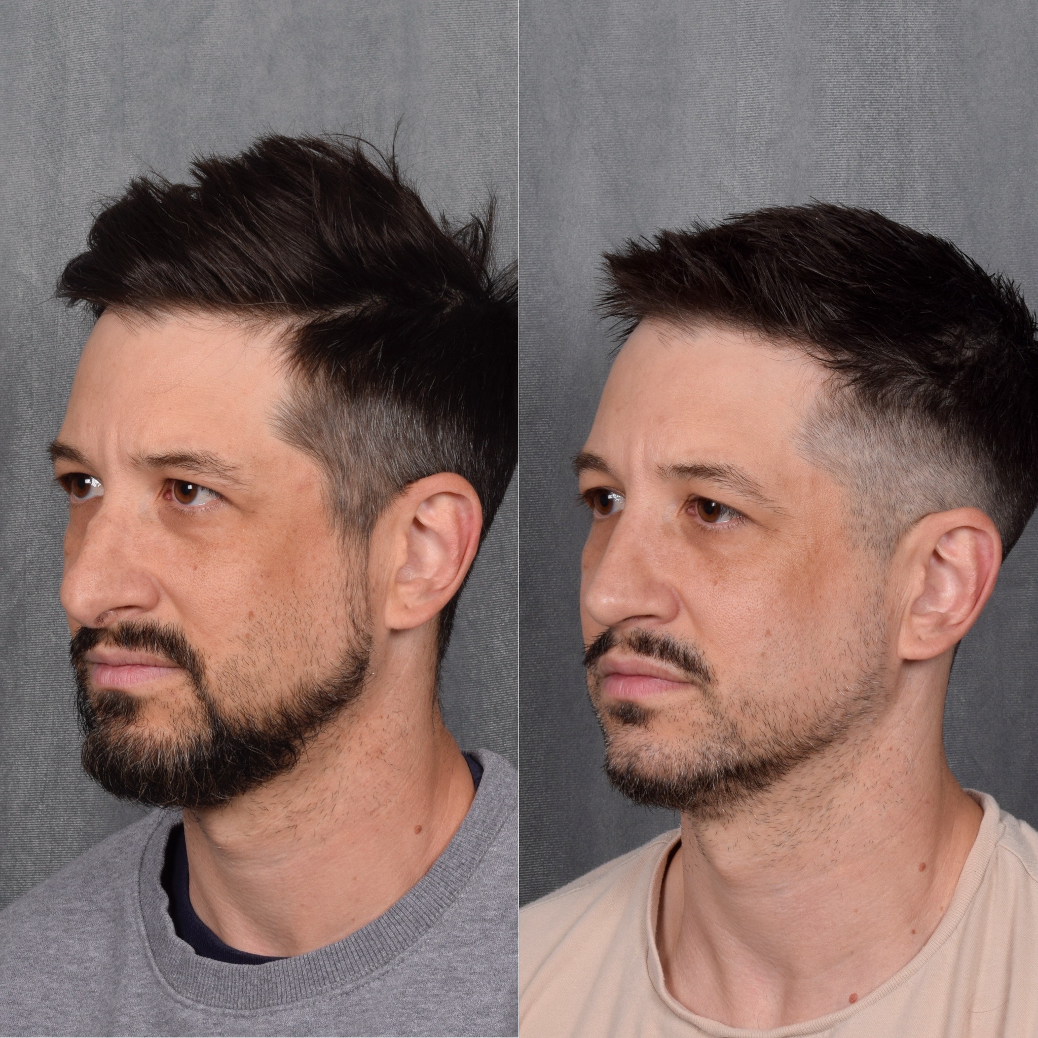 Male Rhinoplasty  Before & After Gallery - Patient 389829 - Image 5