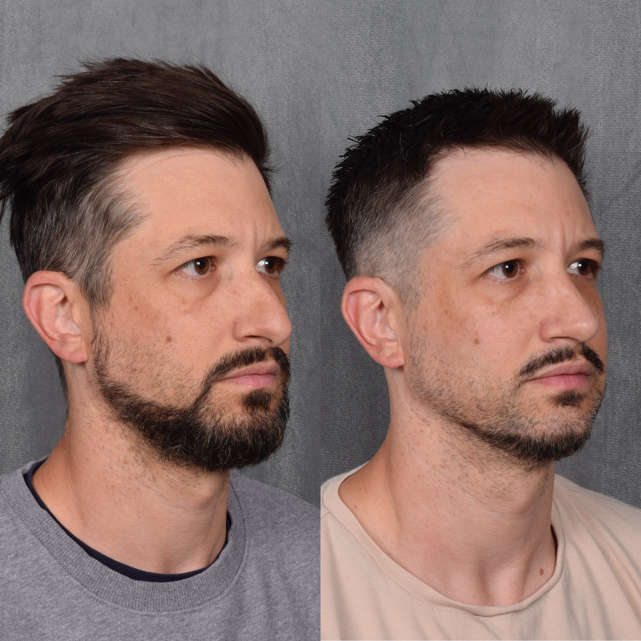Male Rhinoplasty  Before & After Gallery - Patient 389829 - Image 4