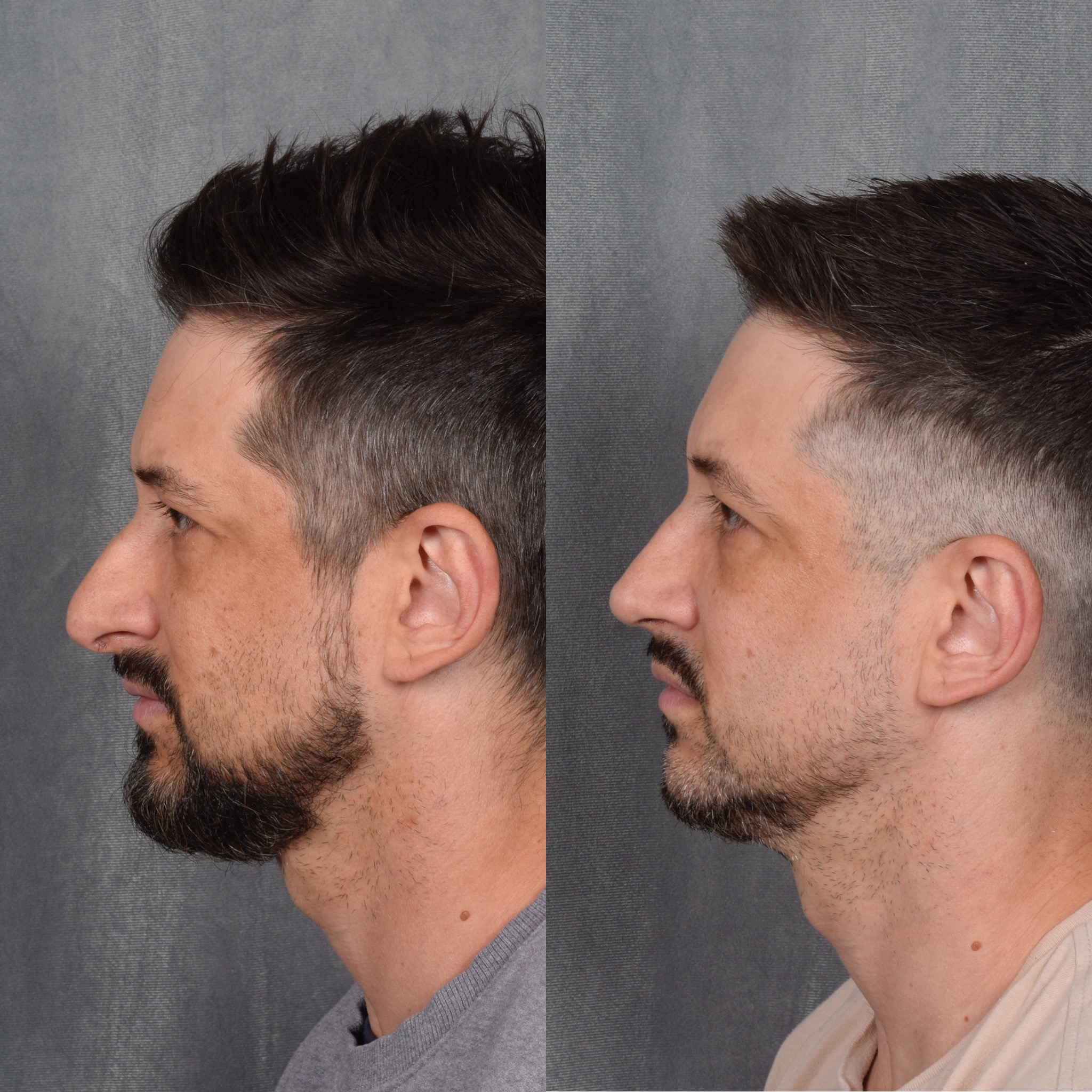 Male Rhinoplasty  Before & After Gallery - Patient 389829 - Image 6