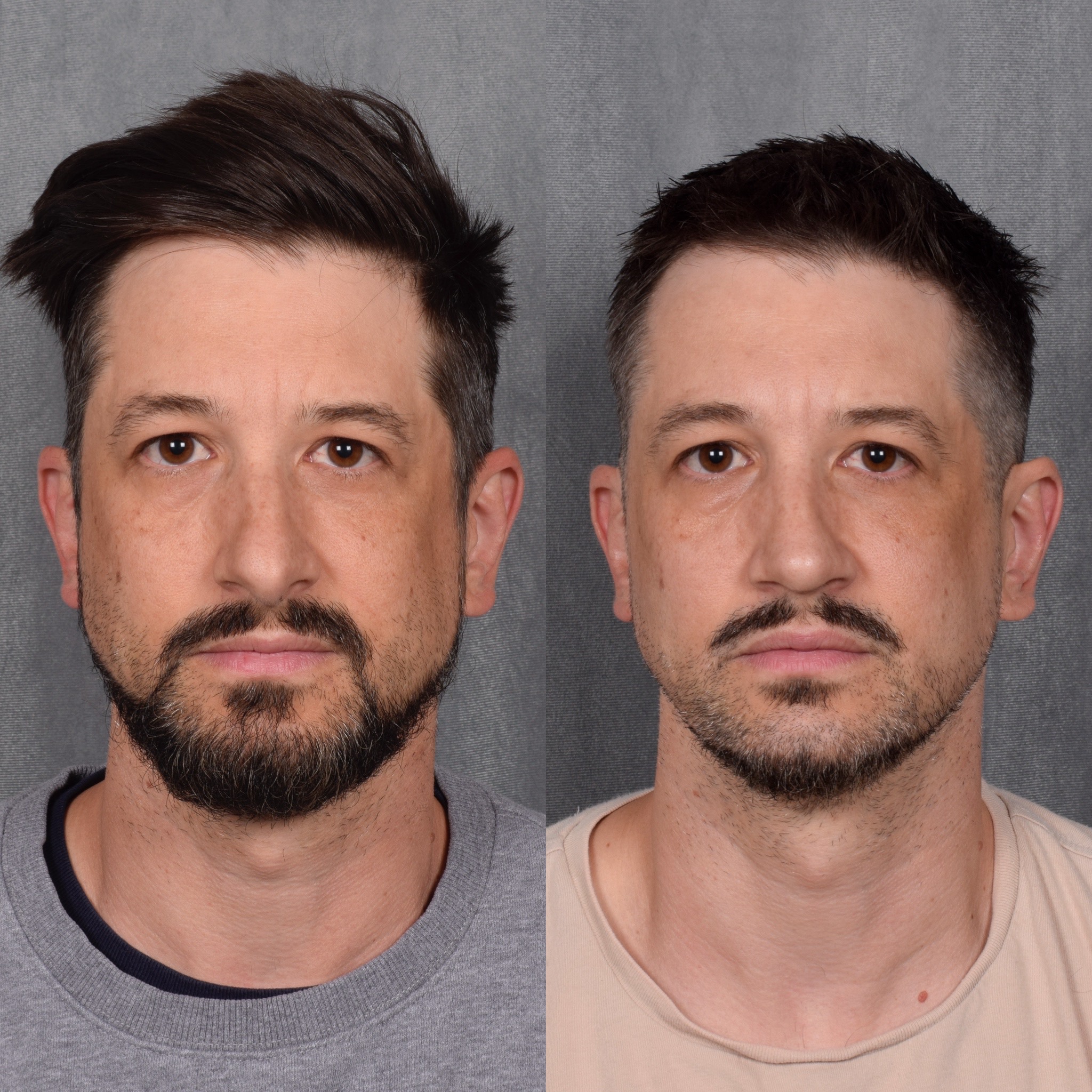 Male Rhinoplasty  Before & After Gallery - Patient 389829 - Image 3