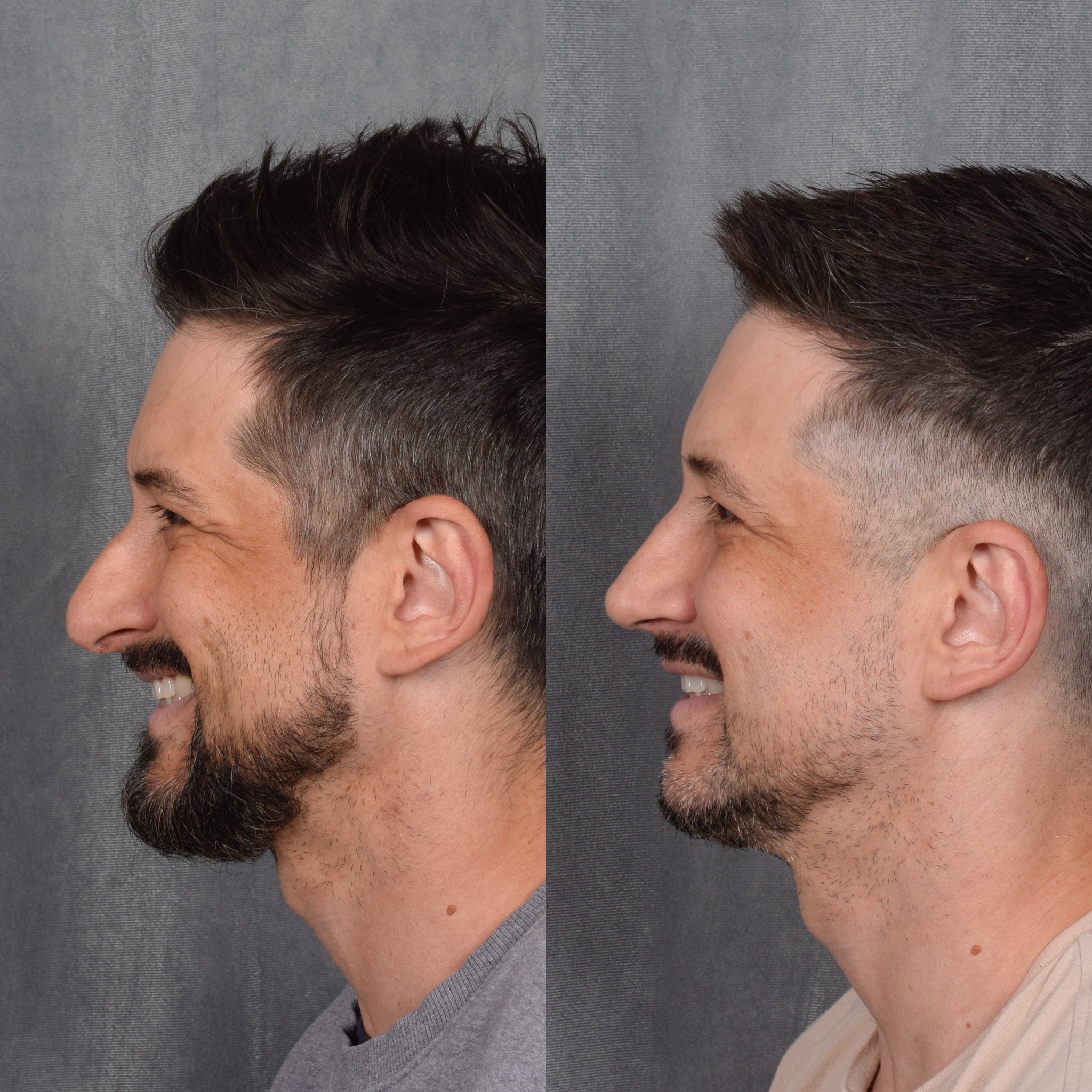 Male Rhinoplasty  Before & After Gallery - Patient 389829 - Image 7