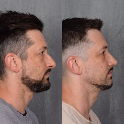 Male Rhinoplasty Before & After Gallery - Patient 389829 - Image 1