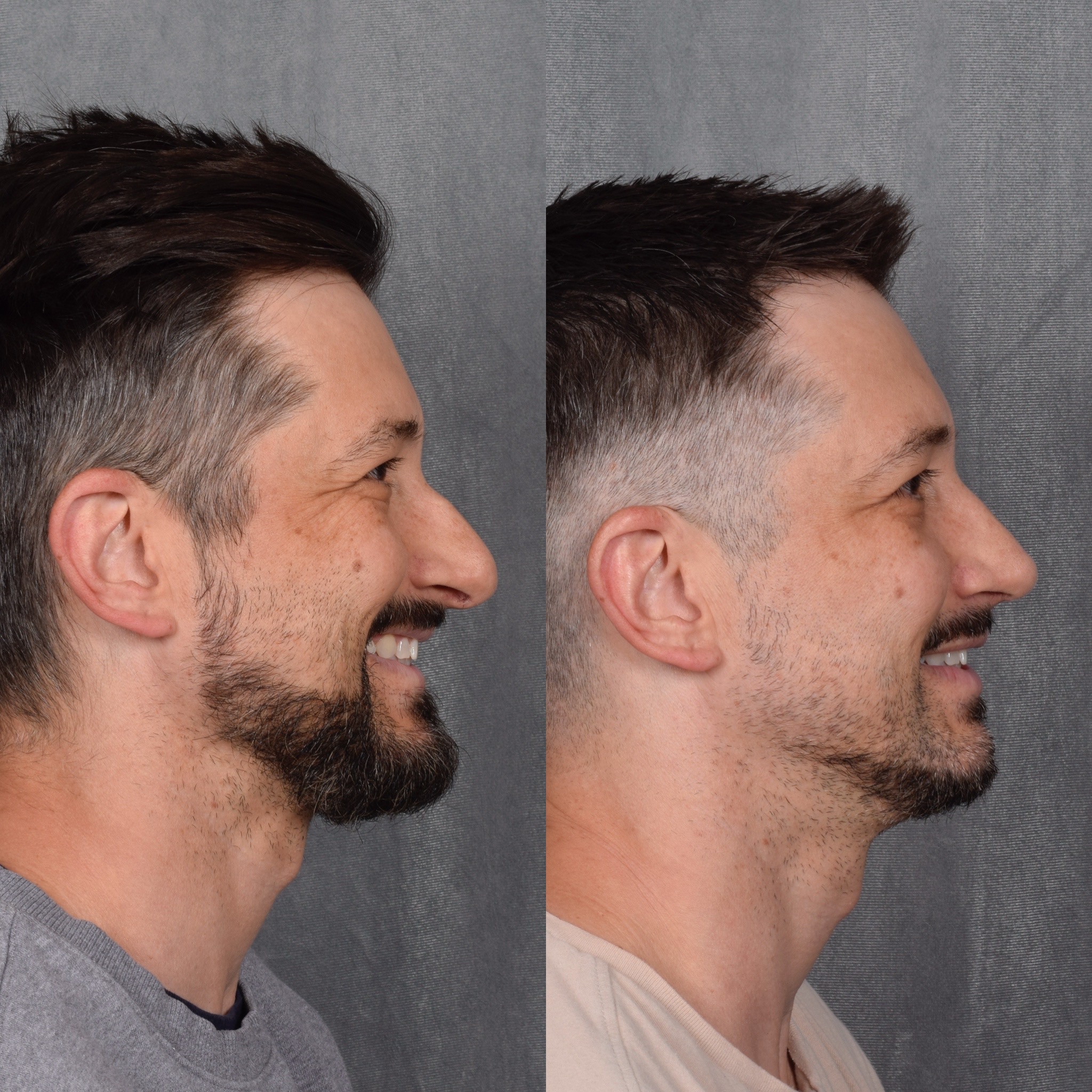 Male Rhinoplasty  Before & After Gallery - Patient 389829 - Image 2
