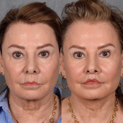 Neck Lift Before & After Gallery - Patient 276308 - Image 1