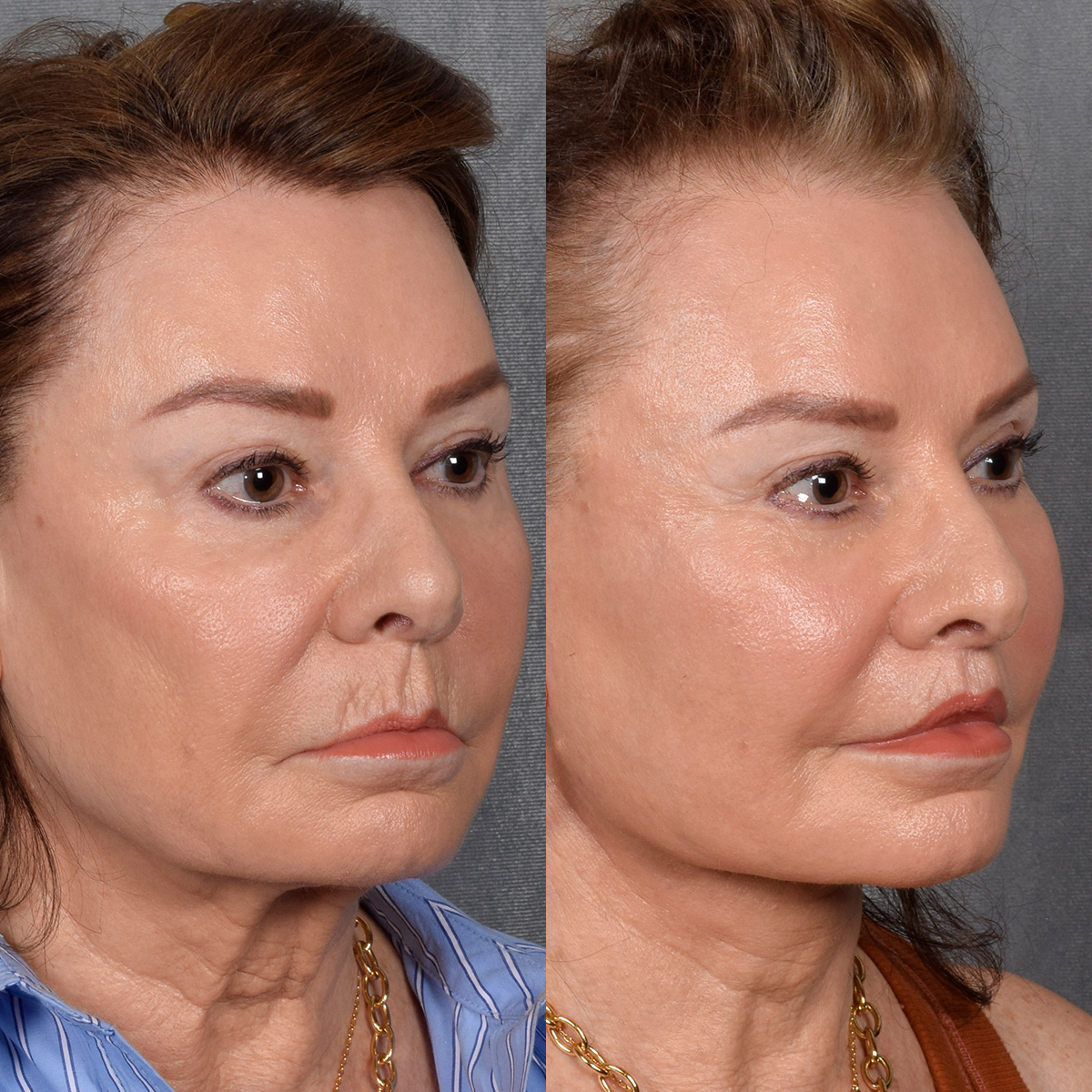 Facelift Before & After Gallery - Patient 301675 - Image 2