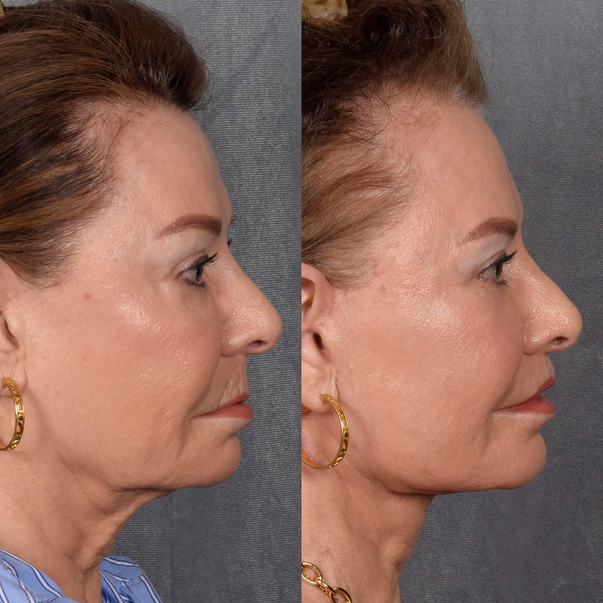 Facelift Before & After Gallery - Patient 301675 - Image 3