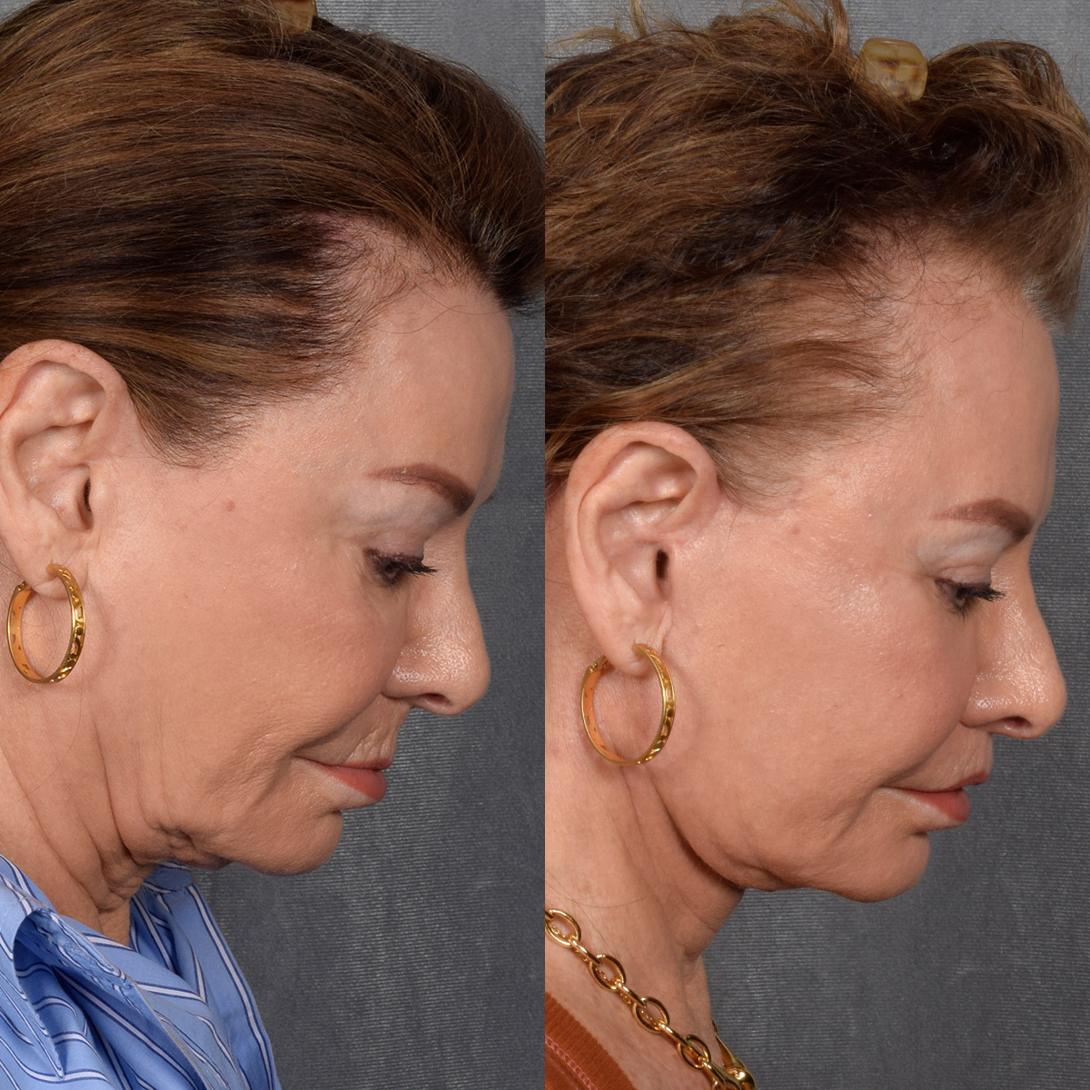 Facelift Before & After Gallery - Patient 301675 - Image 4