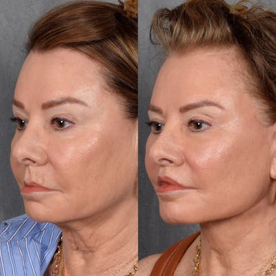 Facelift Before & After Gallery - Patient 301675 - Image 1