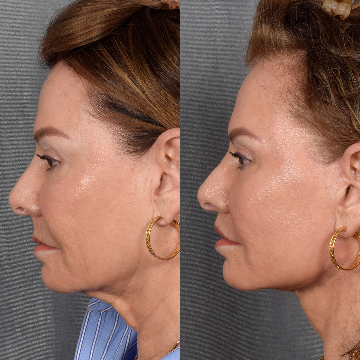 Facelift Before & After Gallery - Patient 301675 - Image 6