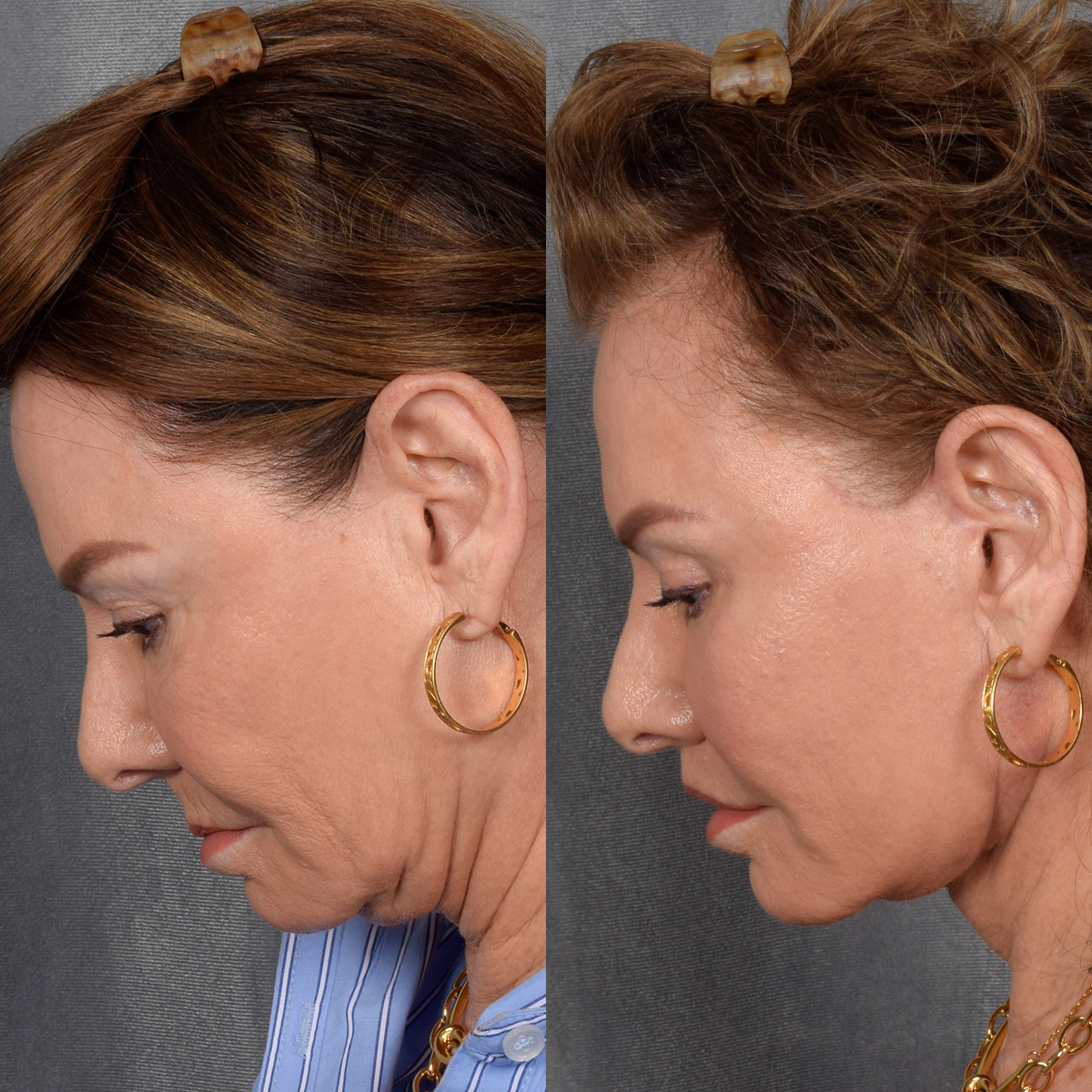 Facelift Before & After Gallery - Patient 301675 - Image 7