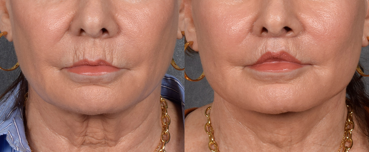 Lip Lift Before & After Gallery - Patient 186249 - Image 1
