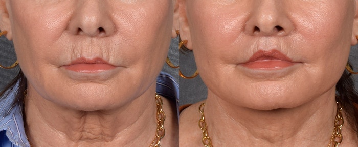 Lip Lift Before & After Gallery - Patient 186249 - Image 1