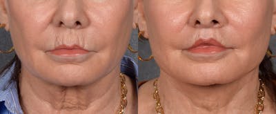 Lip Lift Before & After Gallery - Patient 186249 - Image 1