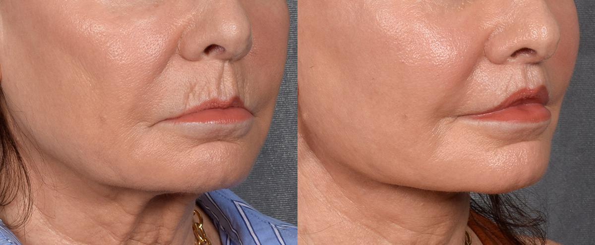Lip Lift Before & After Gallery - Patient 186249 - Image 2