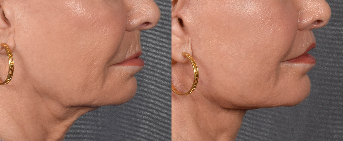 Lip Lift Before & After Gallery - Patient 186249 - Image 3