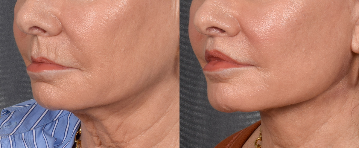 Lip Lift Before & After Gallery - Patient 186249 - Image 4