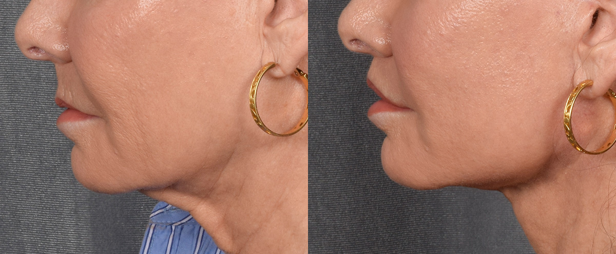 Lip Lift Before & After Gallery - Patient 186249 - Image 5