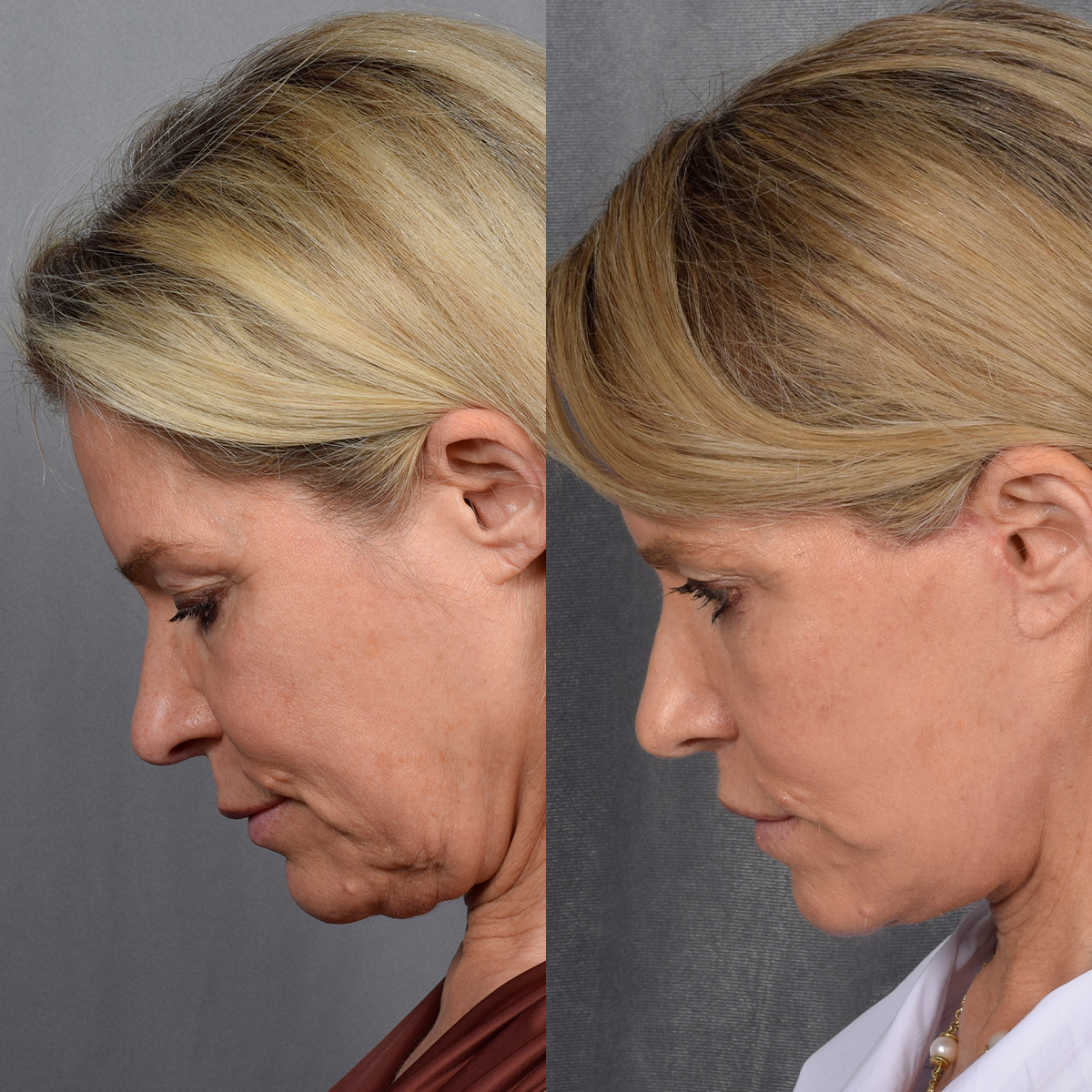 Facelift Before & After Gallery - Patient 110525 - Image 6