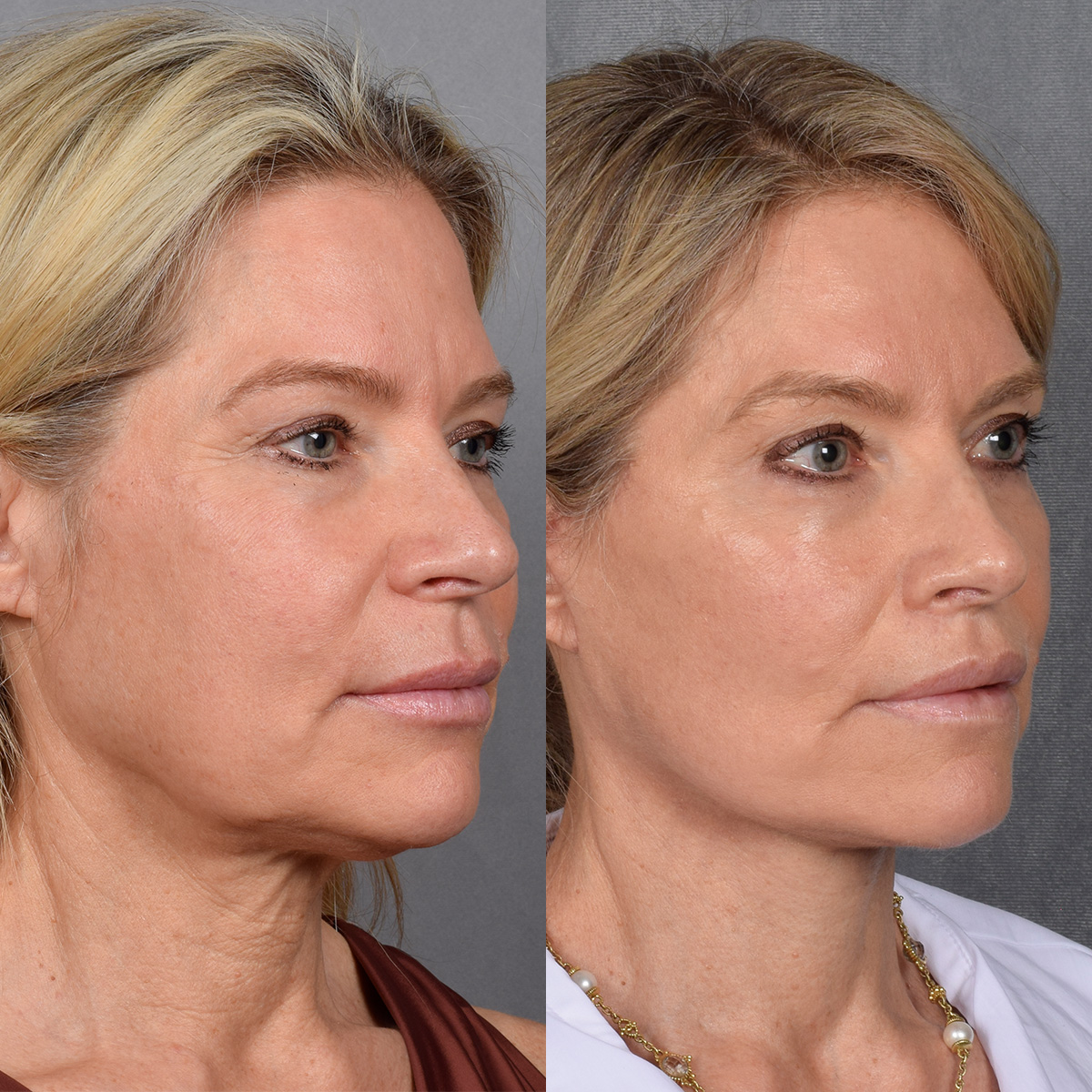 Facelift Before & After Gallery - Patient 110525 - Image 3