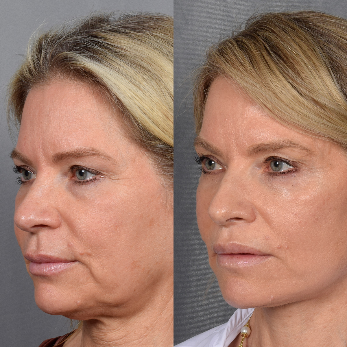 Facelift Before & After Gallery - Patient 110525 - Image 1