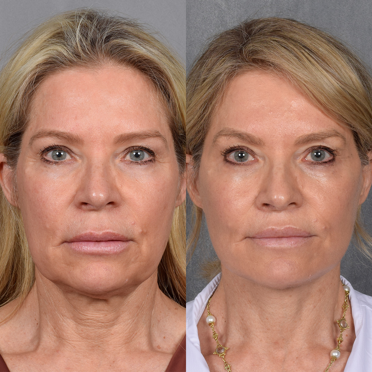 Facelift Before & After Gallery - Patient 110525 - Image 2