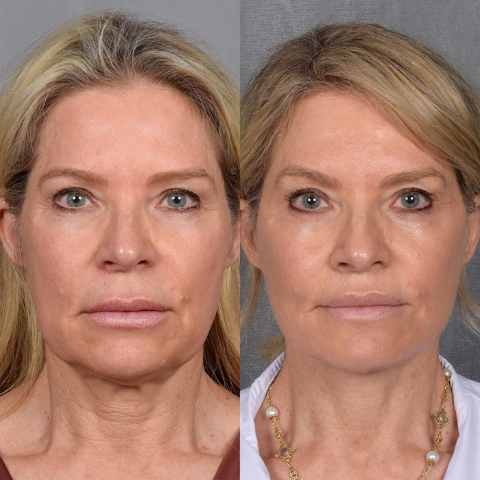 Neck Lift Before & After Gallery - Patient 124548 - Image 1