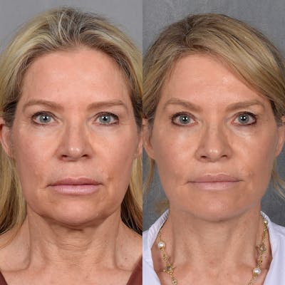 Neck Lift Before & After Gallery - Patient 124548 - Image 1