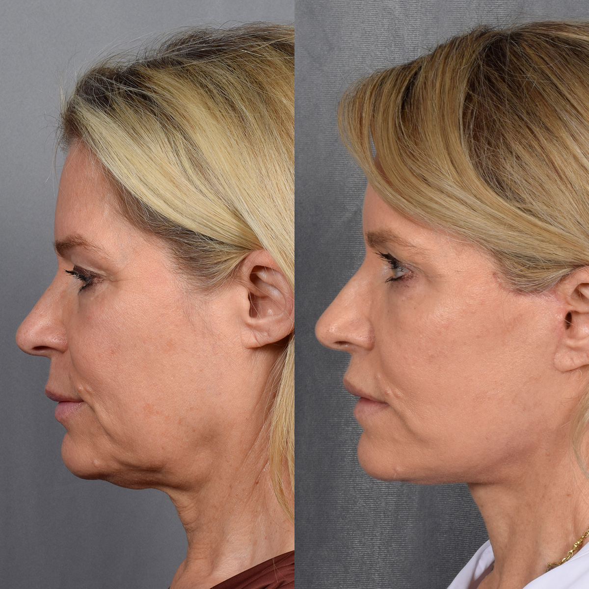 Facelift Before & After Gallery - Patient 110525 - Image 7