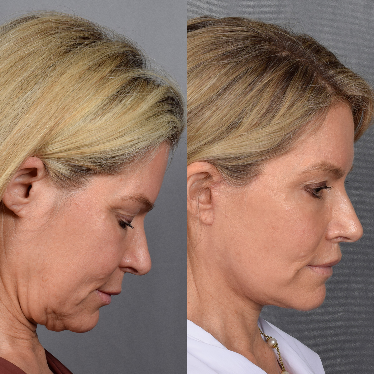 Facelift Before & After Gallery - Patient 110525 - Image 4