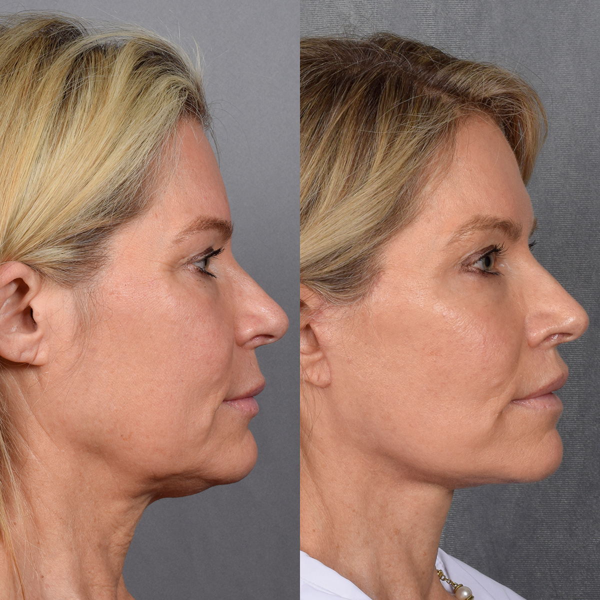 Facelift Before & After Gallery - Patient 110525 - Image 5
