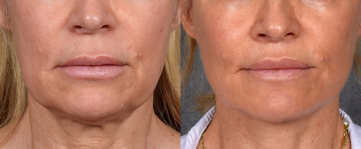 Lip Lift Before & After Gallery - Patient 329011 - Image 1