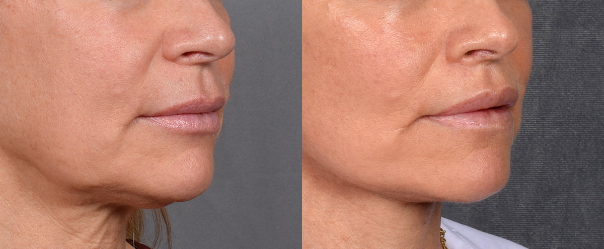 Lip Lift Before & After Gallery - Patient 329011 - Image 2