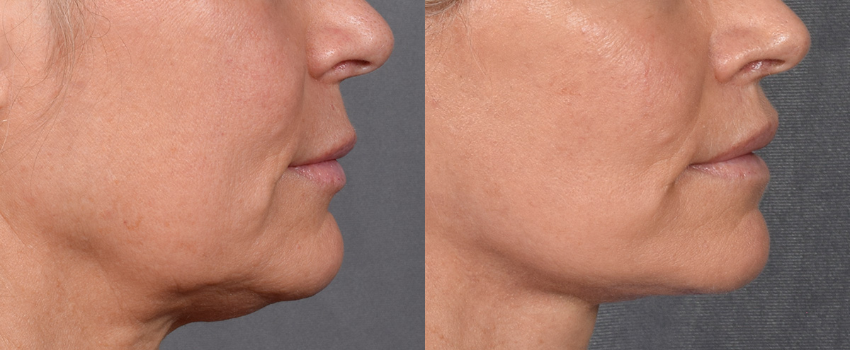 Lip Lift Before & After Gallery - Patient 329011 - Image 3