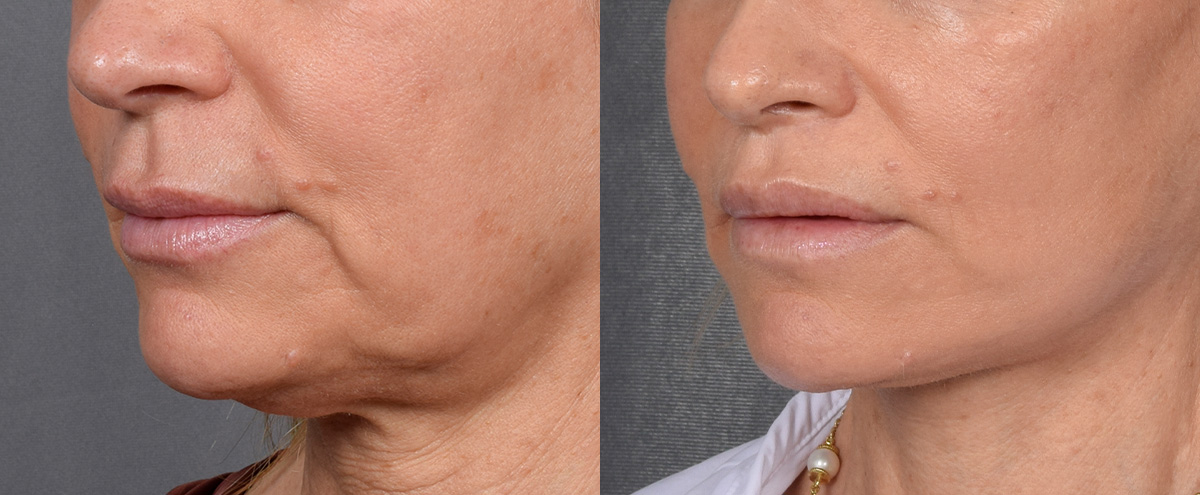 Lip Lift Before & After Gallery - Patient 329011 - Image 4
