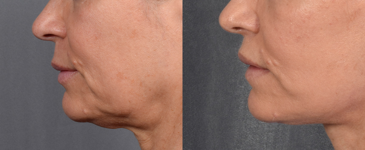 Lip Lift Before & After Gallery - Patient 329011 - Image 5