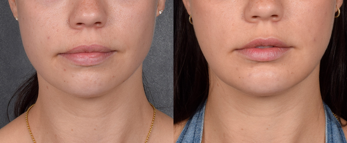Chin Implant Before & After Gallery - Patient 380338 - Image 3