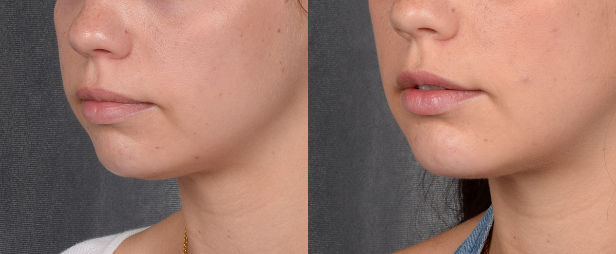 Chin Implant Before & After Gallery - Patient 380338 - Image 1