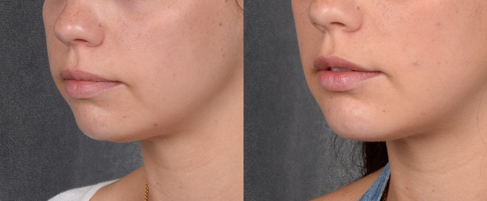 Chin Implant Before & After Gallery - Patient 380338 - Image 1