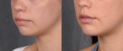 Chin Implant Before & After Gallery - Patient 380338 - Image 1