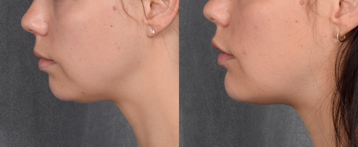 Chin Implant Before & After Gallery - Patient 380338 - Image 2