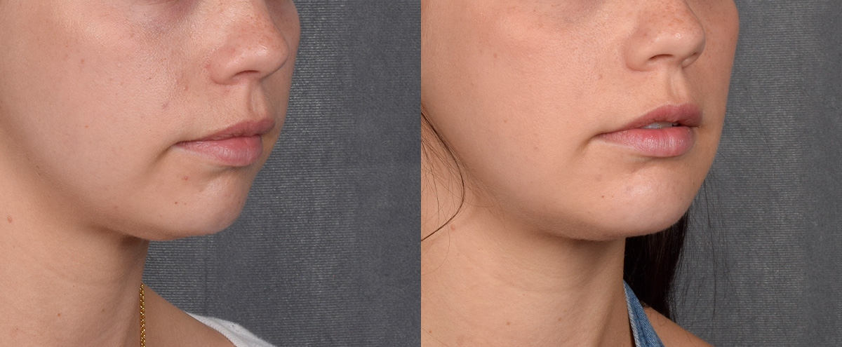 Chin Implant Before & After Gallery - Patient 380338 - Image 4