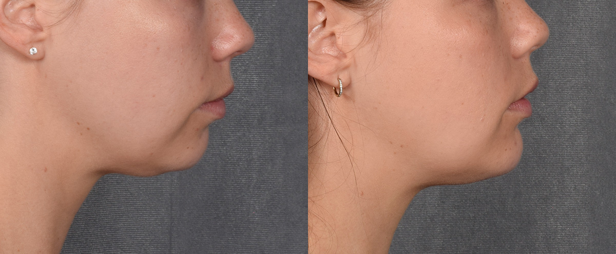 Chin Implant Before & After Gallery - Patient 380338 - Image 5