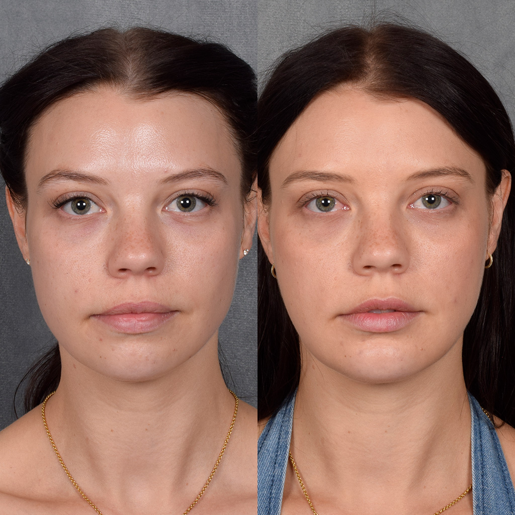 Fat Transfer Before & After Gallery - Patient 301870 - Image 1