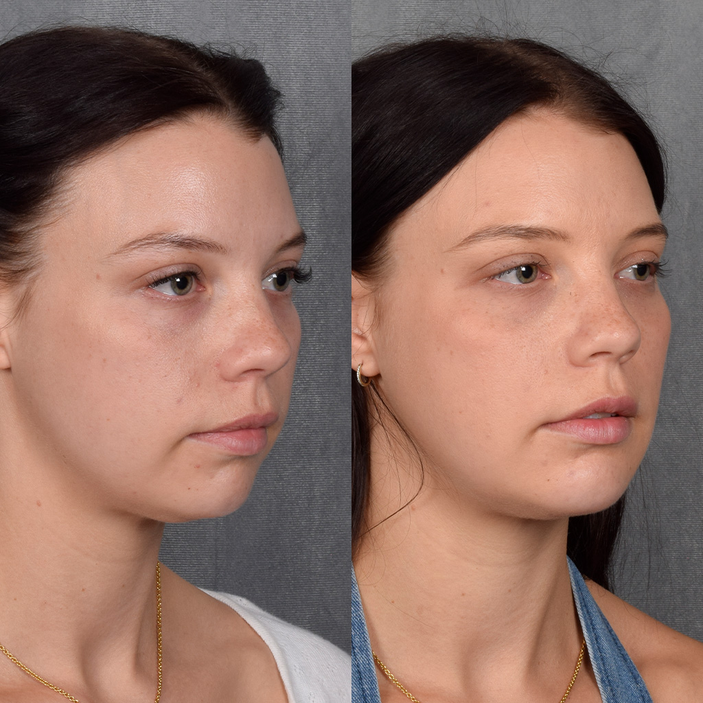 Fat Transfer Before & After Gallery - Patient 301870 - Image 2