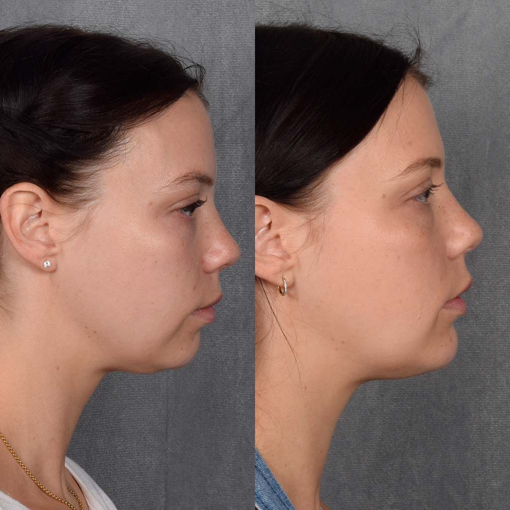 Fat Transfer Before & After Gallery - Patient 301870 - Image 3