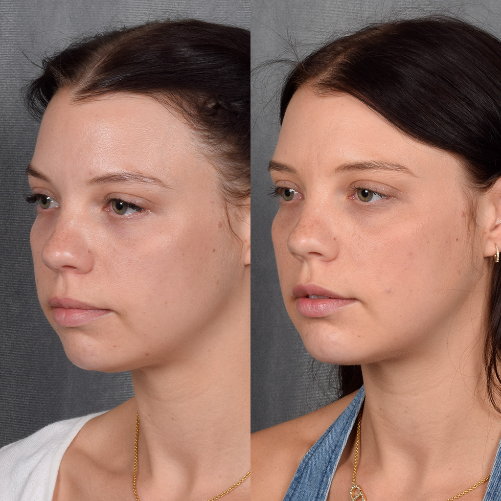 Fat Transfer Before & After Gallery - Patient 301870 - Image 4