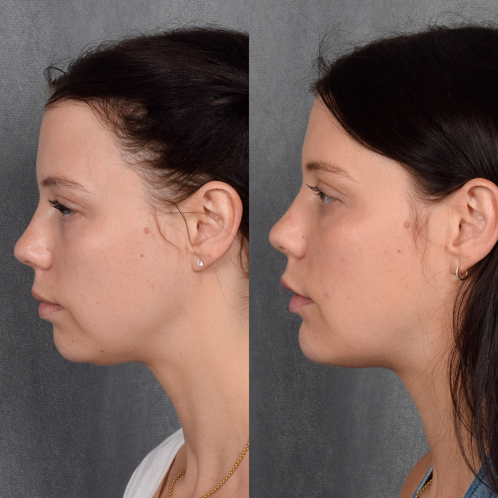 Fat Transfer Before & After Gallery - Patient 301870 - Image 5