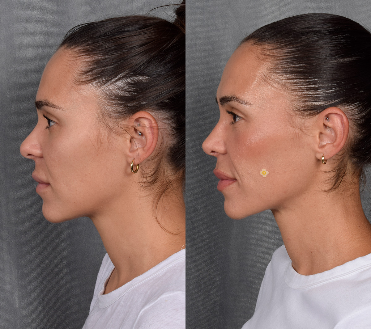 Rhinoplasty Before & After Gallery - Patient 260178 - Image 2